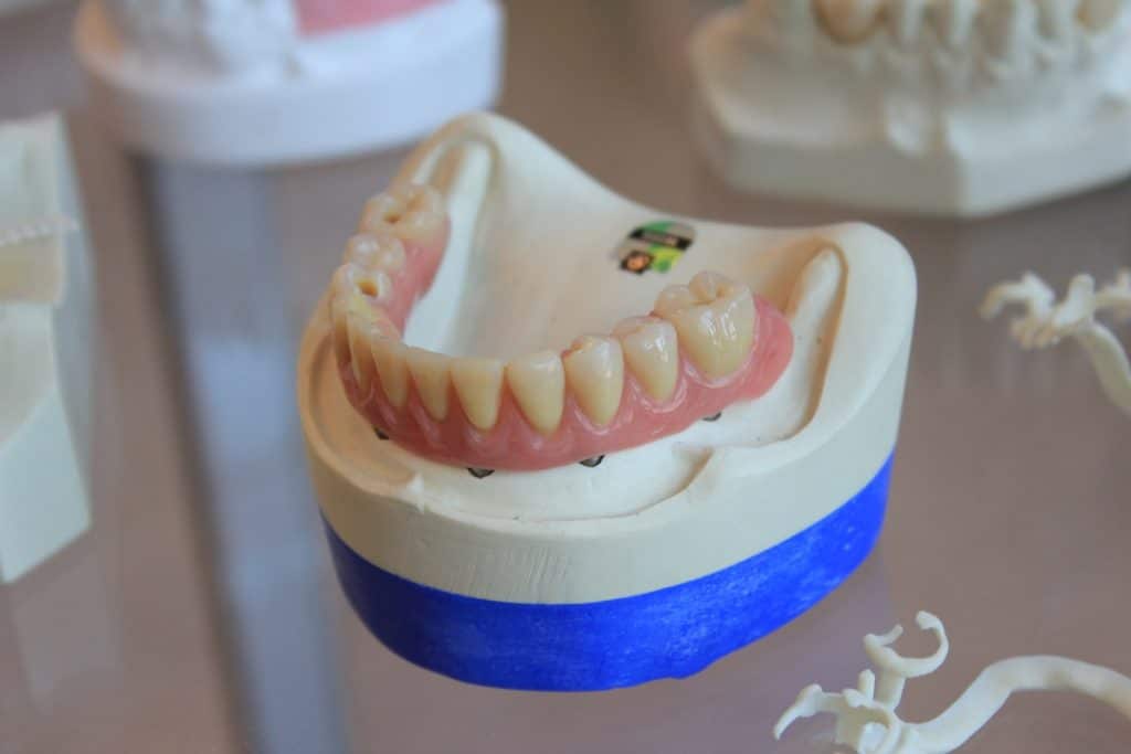 Prothèse dentaire pour mâchoire complète avec implants